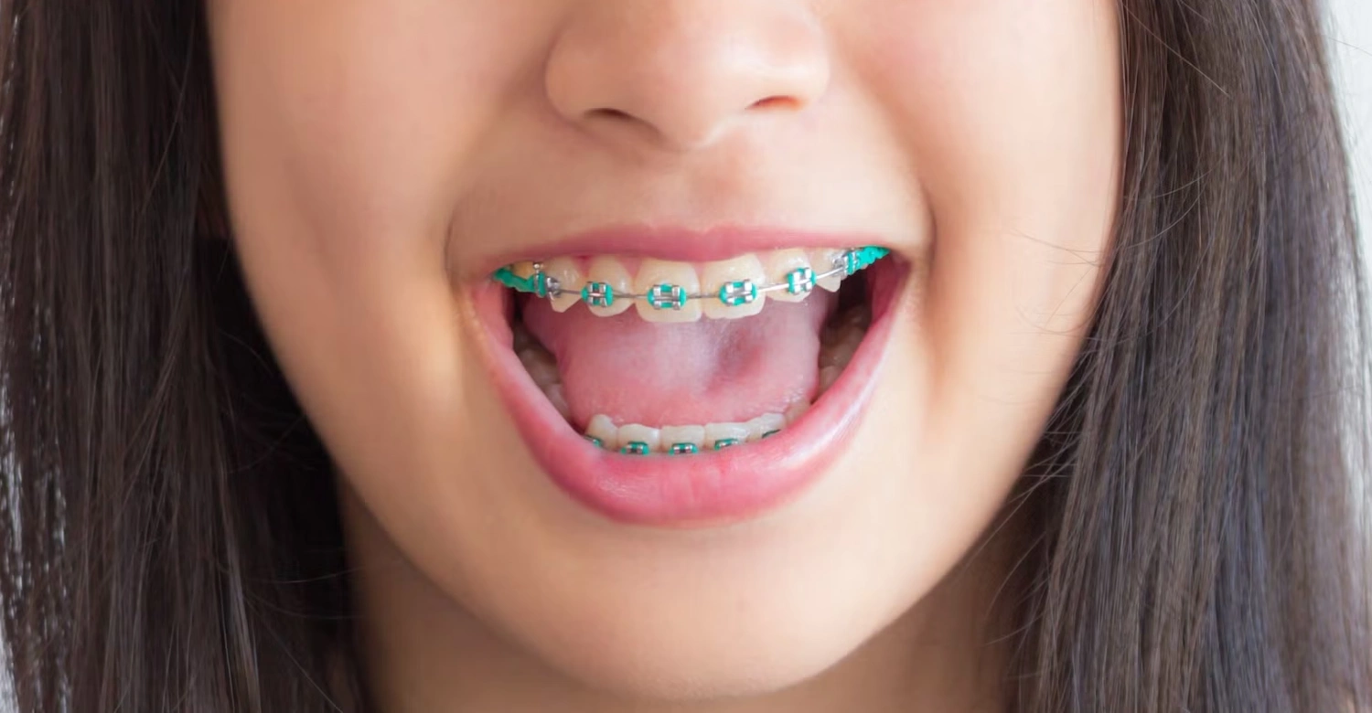 What is the Best Age for Braces Inblog